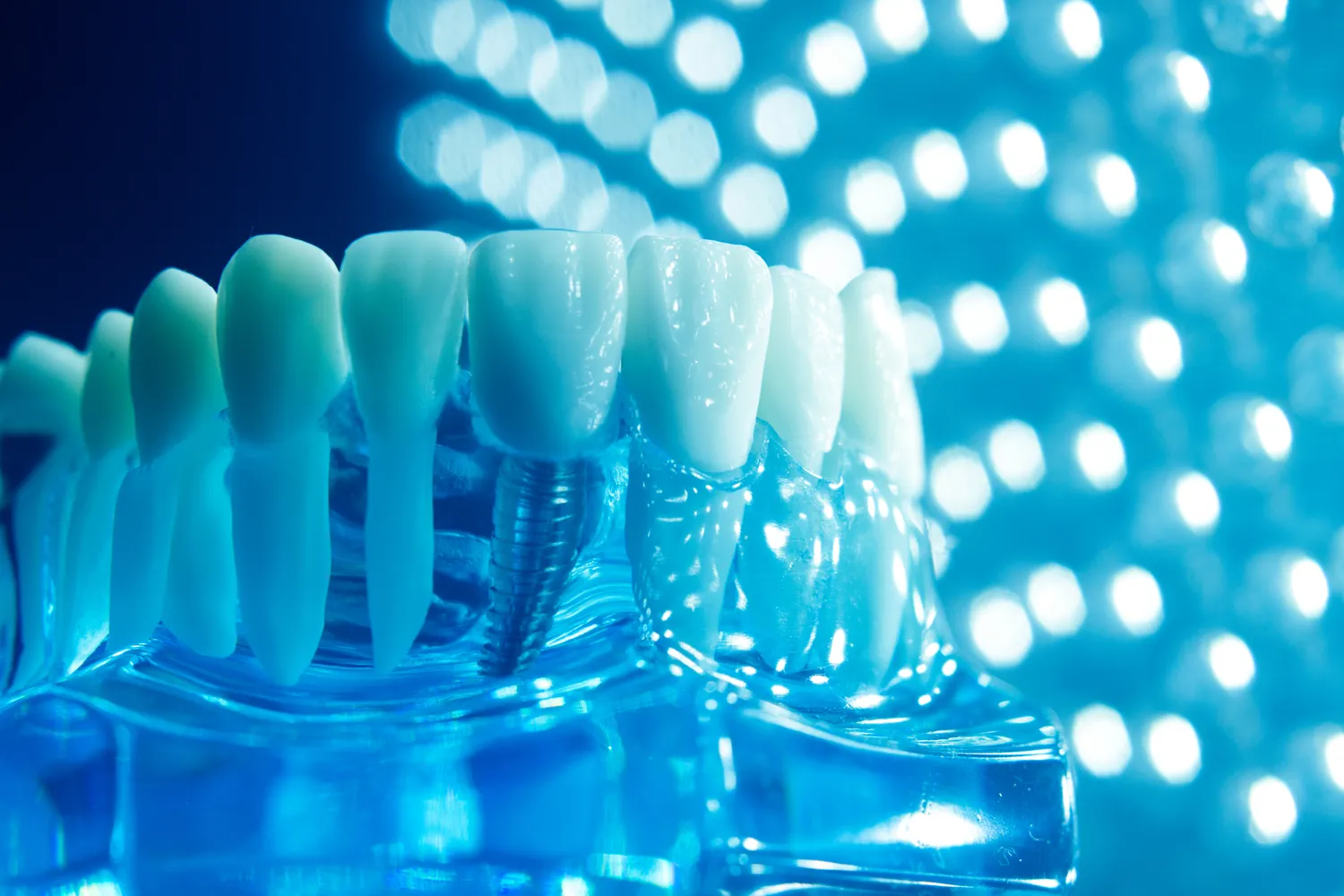 Bezśrubowe implanty co to?