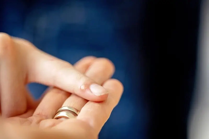 Czy kurzajki swędzą?